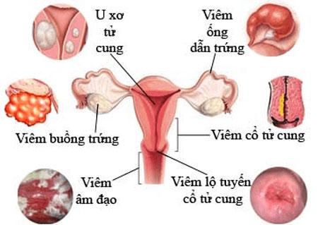 Sơ đồ các loại viêm nhiễm đường sinh dục nữ và vị trí giải phẫu tương ứng