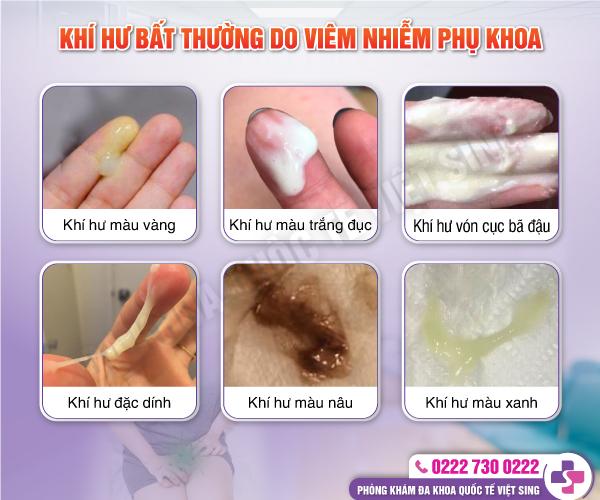 Các dấu hiệu nhận biết viêm nhiễm vùng kín ở phụ nữ bao gồm ngứa ngáy, khí hư bất thường và đau rát