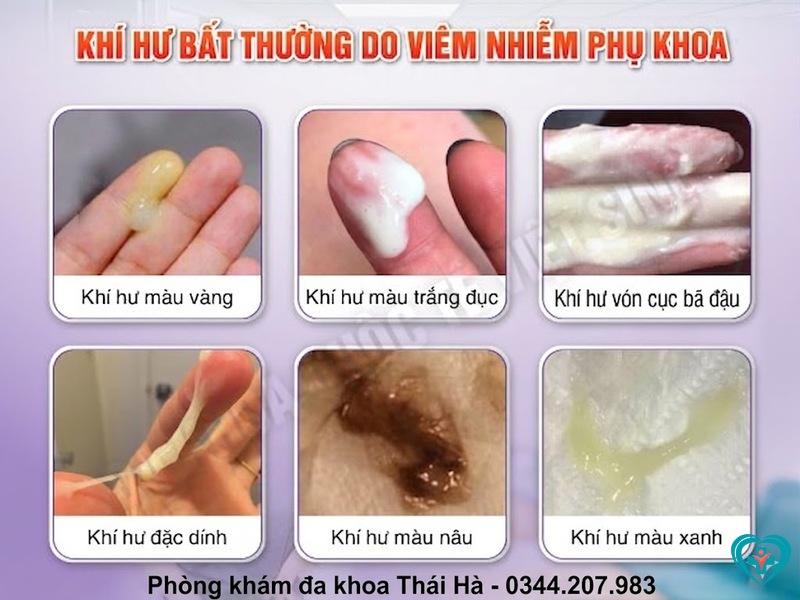 Minh họa các biểu hiện bất thường của khí hư như thay đổi màu sắc, mùi hôi, kết cấu bất thường do viêm nhiễm phụ khoa
