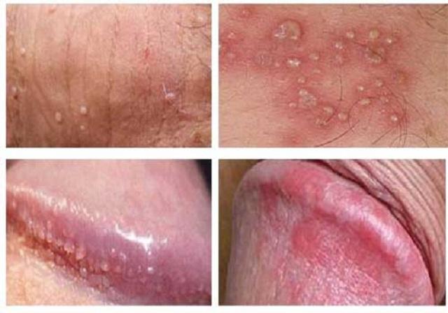 Các nguyên nhân chính gây viêm nhiễm vùng kín ở nam giới như vệ sinh kém, nấm, vi khuẩn