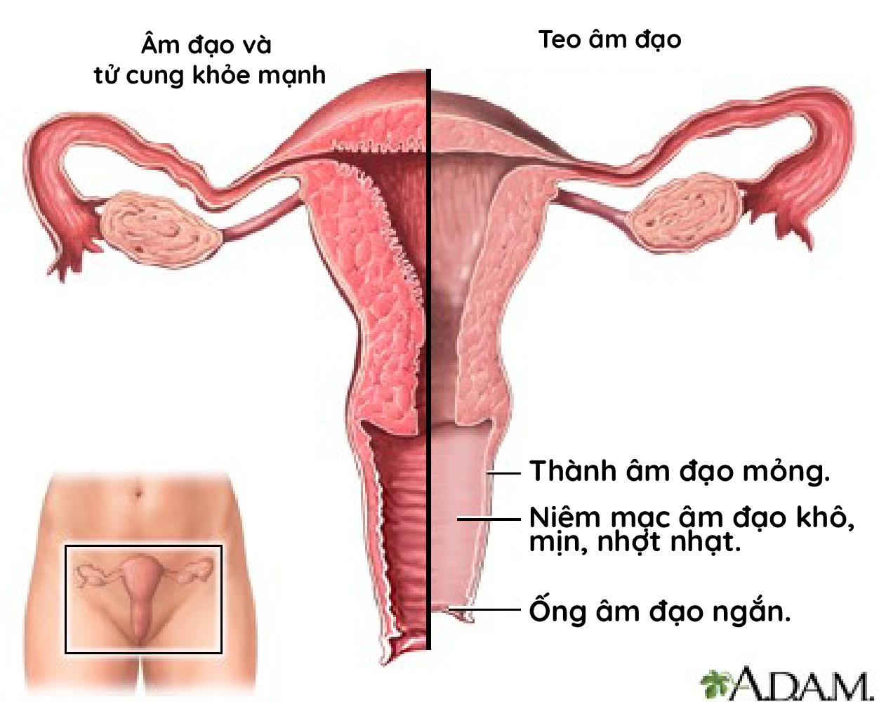 Minh họa sự thay đổi của niêm mạc âm đạo trước và sau mãn kinh do thiếu hụt estrogen