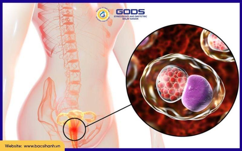 Hình ảnh minh họa các vi khuẩn có hại phát triển quá mức trong môi trường âm đạo, gây mất cân bằng hệ vi sinh và dẫn đến viêm nhiễm phụ khoa